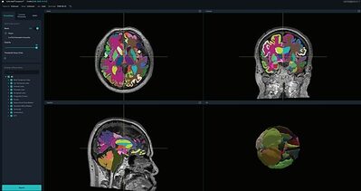 An AI that measures the brain gets its first US clearance